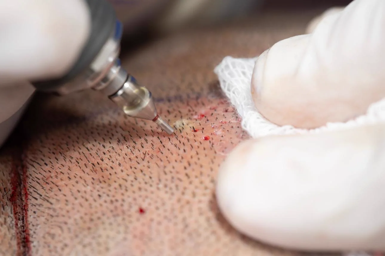 1. FUE Hair Transplant (Follicular Unit Extraction) image 1