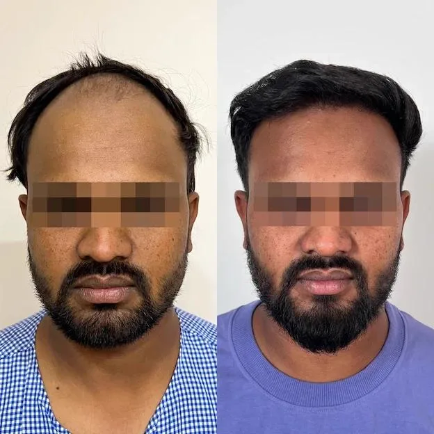 1. FUE Hair Transplant (Follicular Unit Extraction) image 2