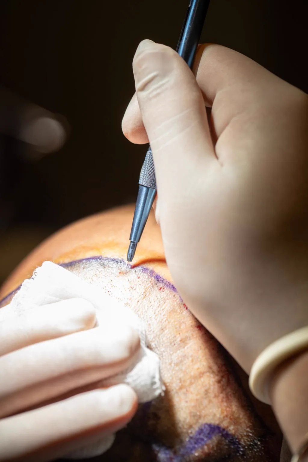 2. FUT Hair Transplant (Strip Method) image 1