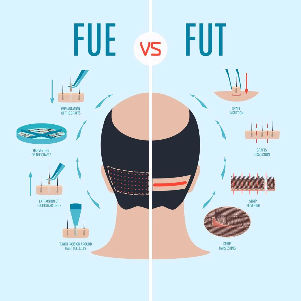 2. FUT Hair Transplant (Strip Method) image 2