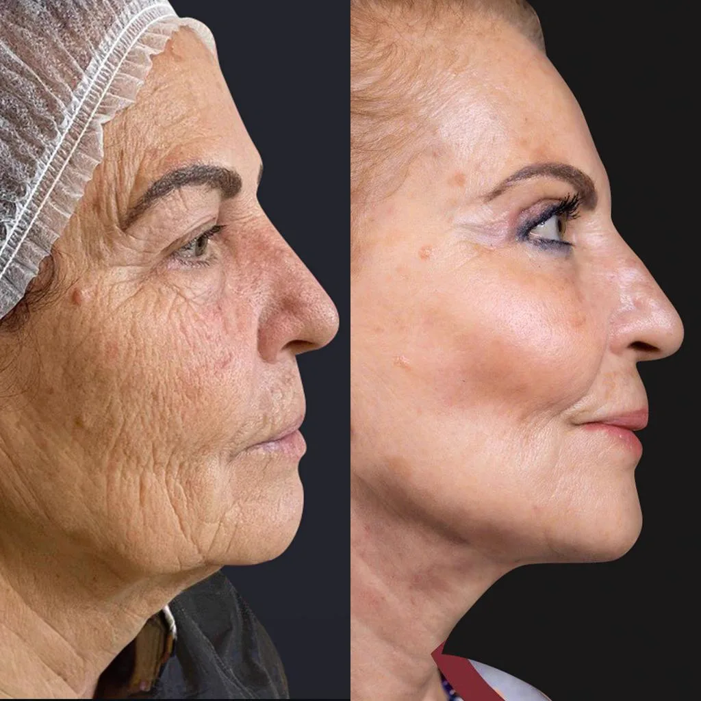 5. Facelift with Fat Grafting / Adjunct Procedures image 1