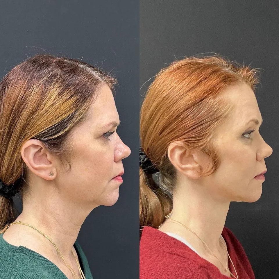 5. Facelift with Fat Grafting / Adjunct Procedures image 2