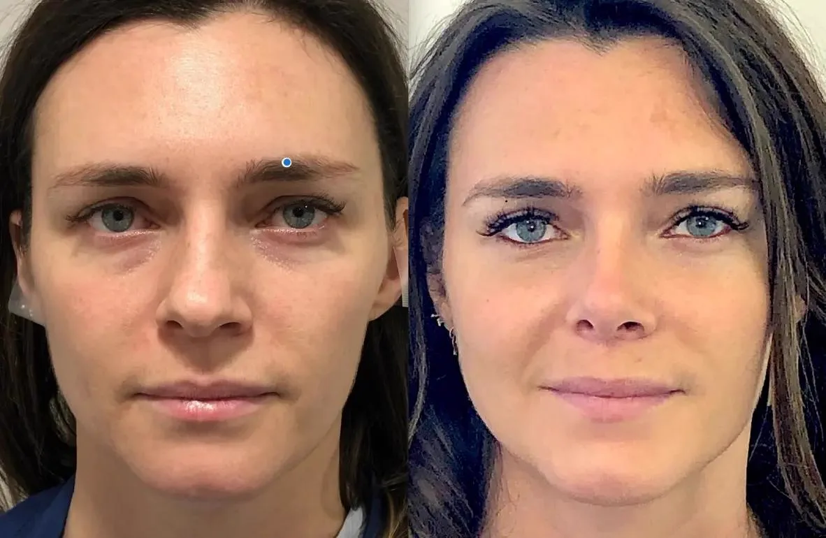 1. Facial Fat Grafting (Facial Rejuvenation) image 2