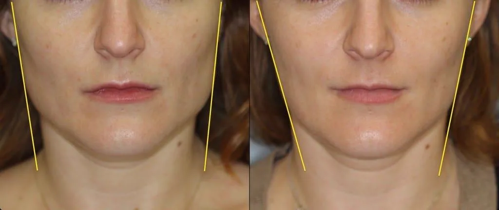 3. Facial Symmetry Correction image 1
