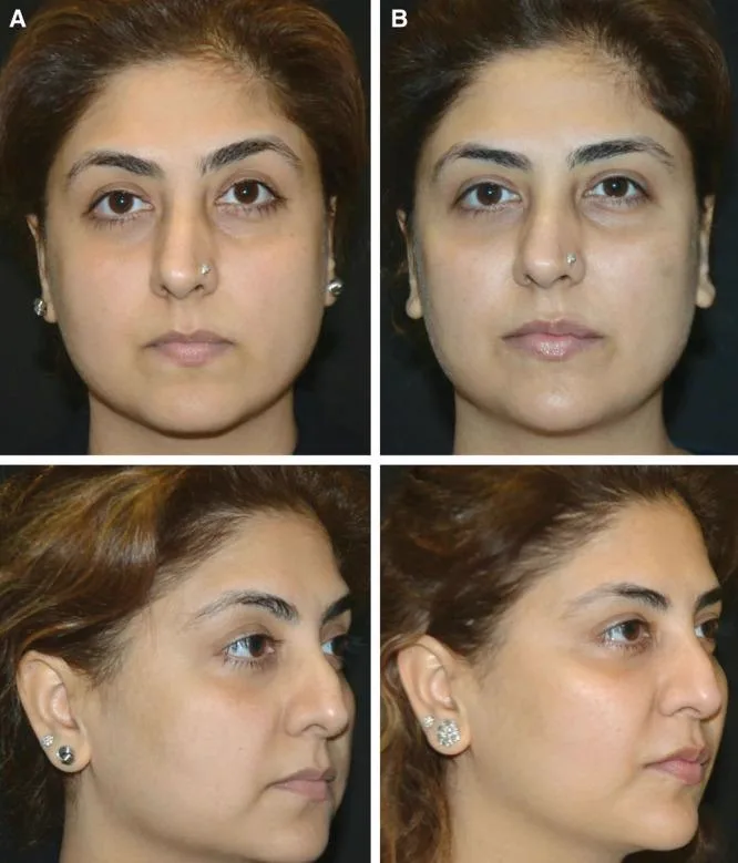 3. Facial Symmetry Correction image 2