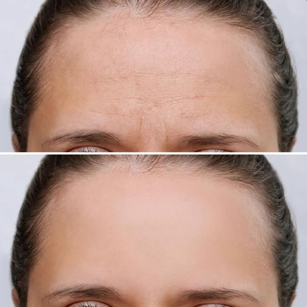 1. Forehead Lines Treatment image 4
