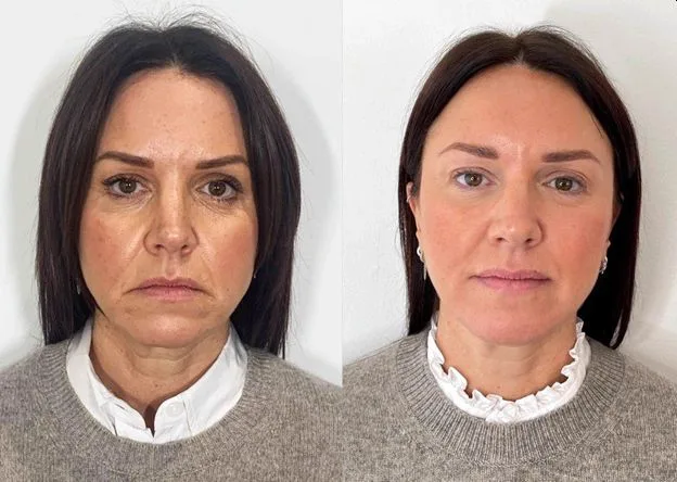 6. Full Face Rejuvenation (Liquid Facelift)