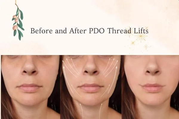 1. Full Face Thread Lift image 1