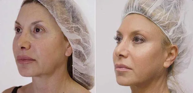 1. Full Face Thread Lift image 2
