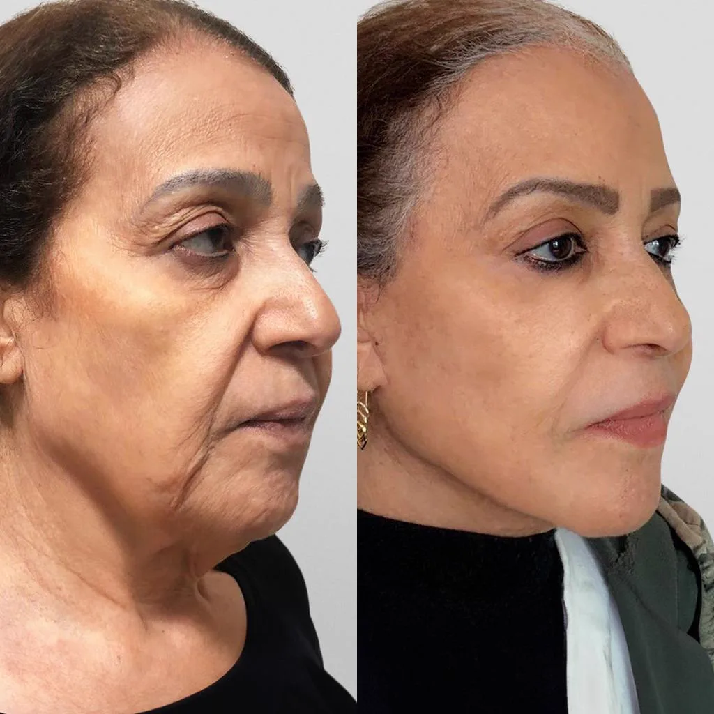 1. Full Facelift Surgery (Traditional Facelift)