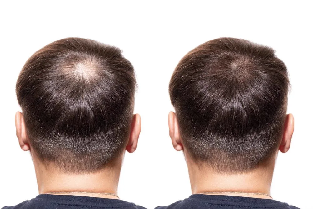 2. GFC / Grofactor Therapy for Hair Regrowth image 3