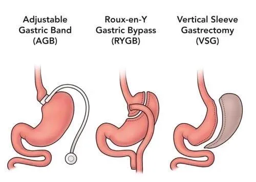 2. Gastric Bypass Surgery image 1