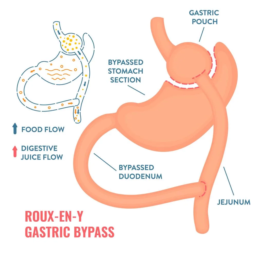 2. Gastric Bypass Surgery image 3