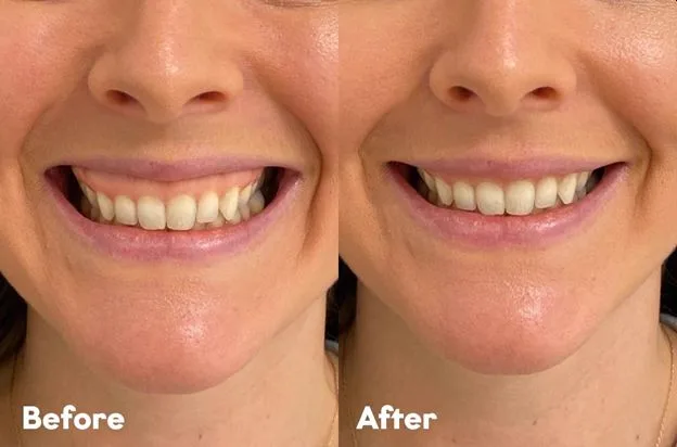 5. Gummy Smile Correction
