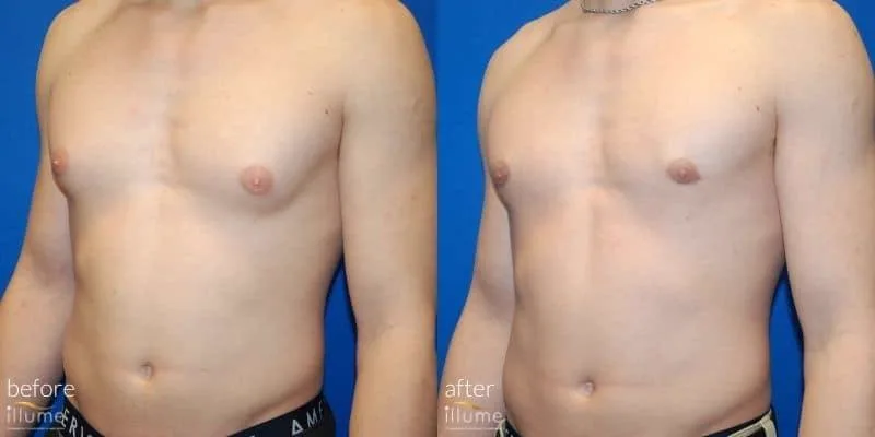 4. Gynecomastia Surgery (Male Chest Reduction) image 1