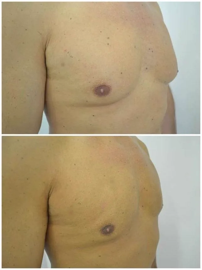 4. Gynecomastia Surgery (Male Chest Reduction) image 2