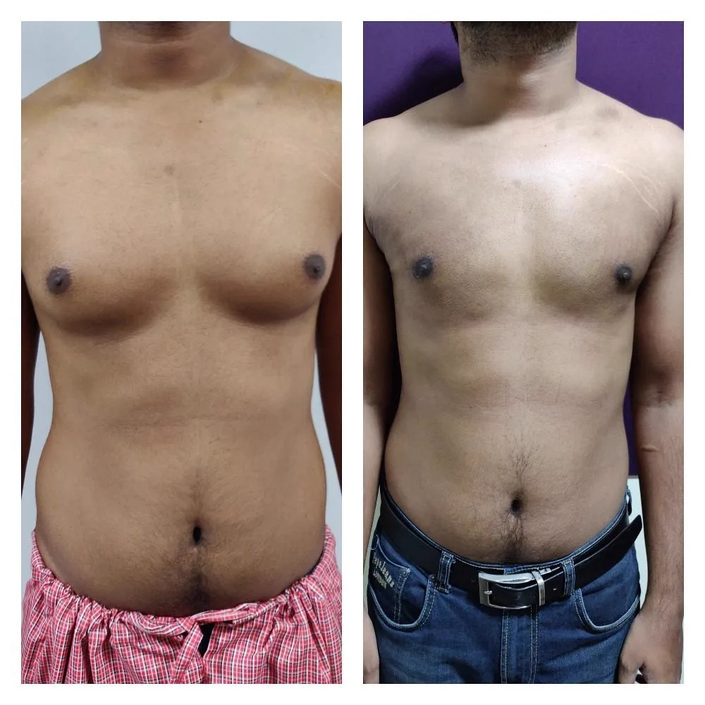 4. Gynecomastia Surgery (Male Chest Reduction) image 3