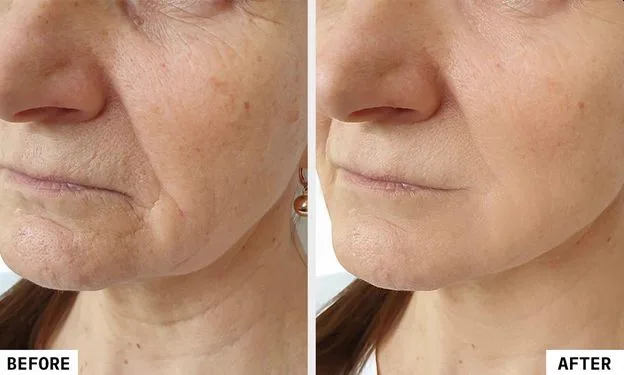 1. HIFU Face Lift (Non-Surgical Facelift) image 1