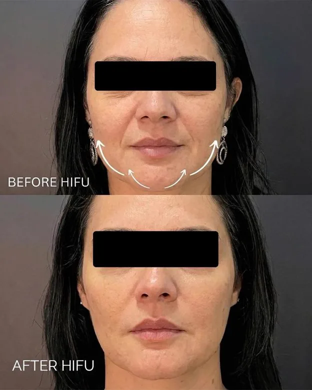 1. HIFU Face Lift (Non-Surgical Facelift) image 2