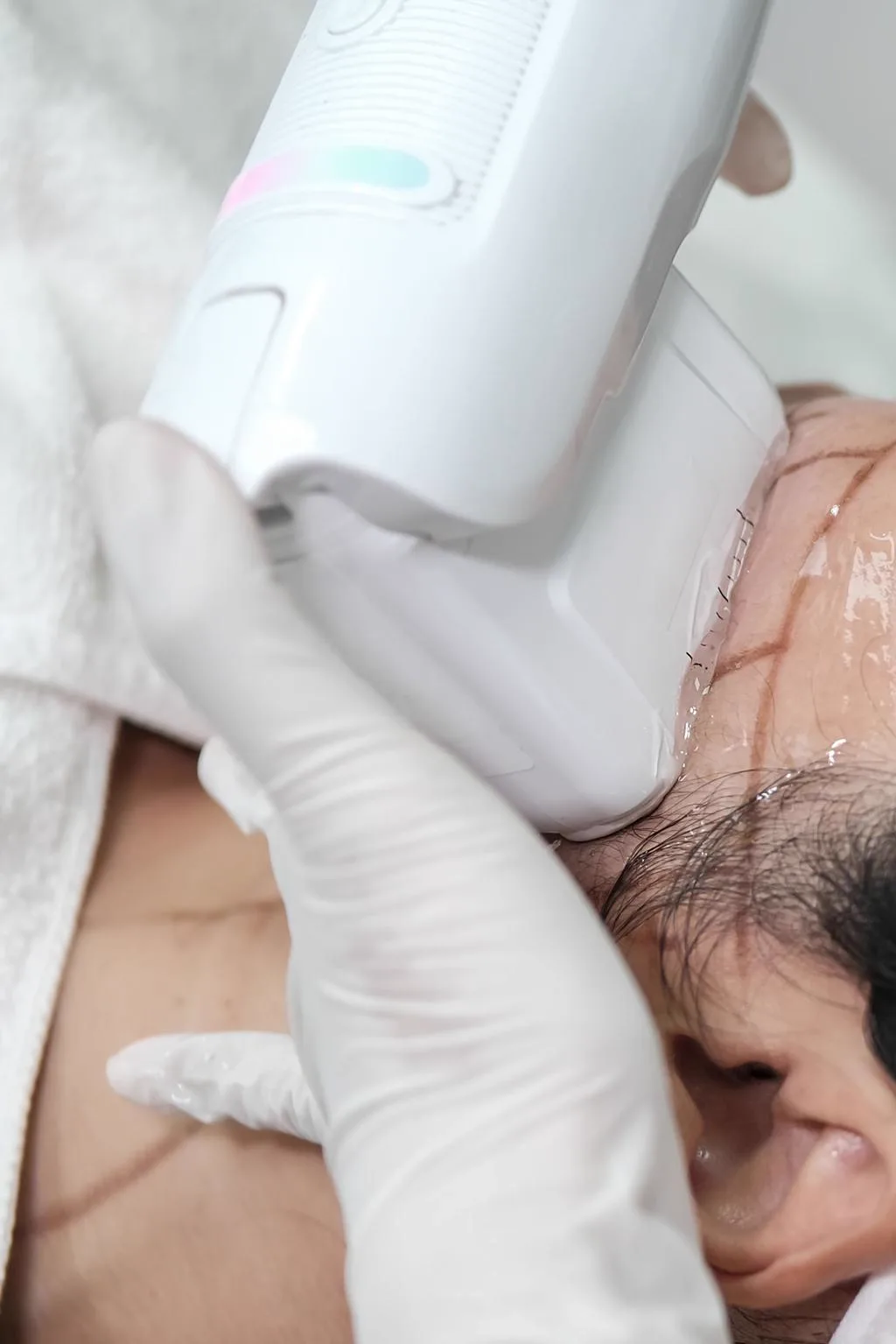 5. HIFU (High-Intensity Focused Ultrasound) image 2