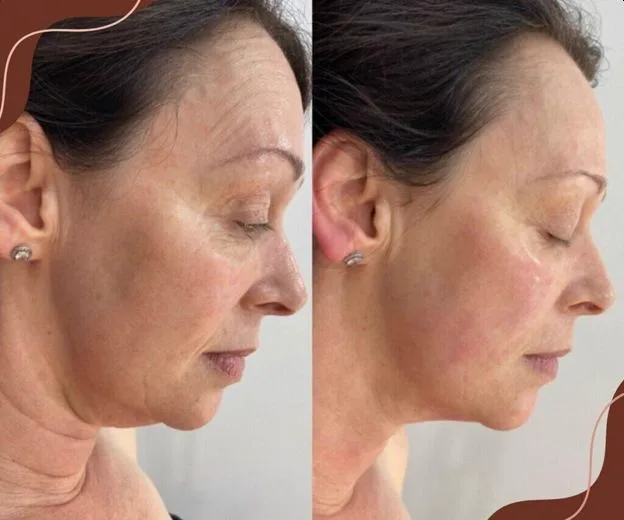 4. HIFU for Skin Tightening (Face & Body) image 1