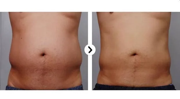 4. HIFU for Skin Tightening (Face & Body) image 2