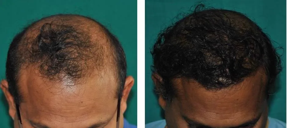 5. Hairline Correction & Design image 1