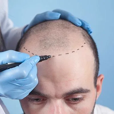 5. Hairline Correction & Design image 2
