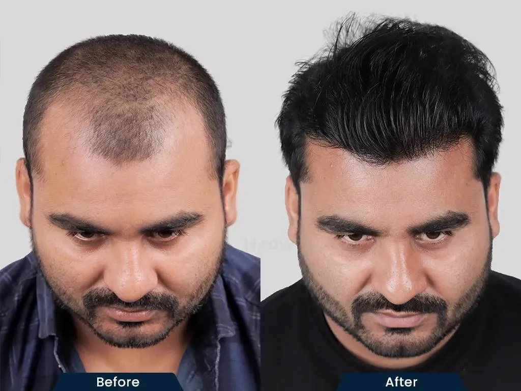 5. Hairline Correction & Design image 3