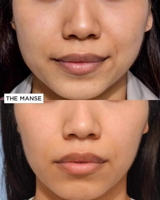 1. Jaw Slimming (Face Contouring) image 2