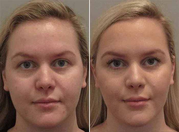 1. Jaw Slimming (Face Contouring) image 3