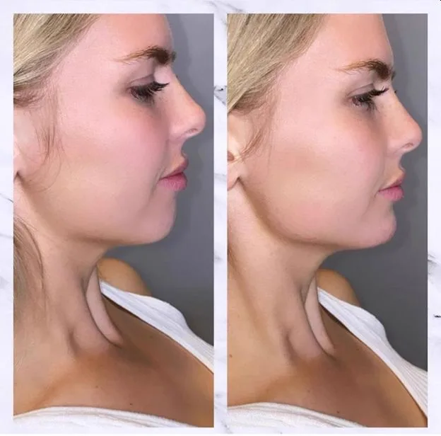 2. Jawline Fillers (Facial Contouring) image 2