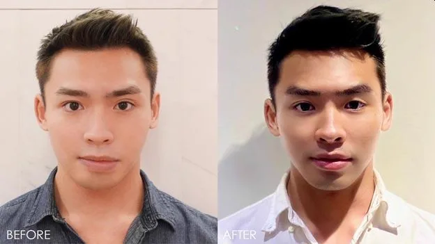 4. Jawline Slimming (Masseter Botox) image 1