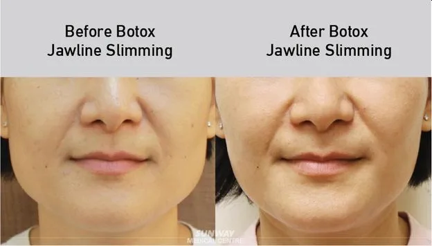 4. Jawline Slimming (Masseter Botox) image 2