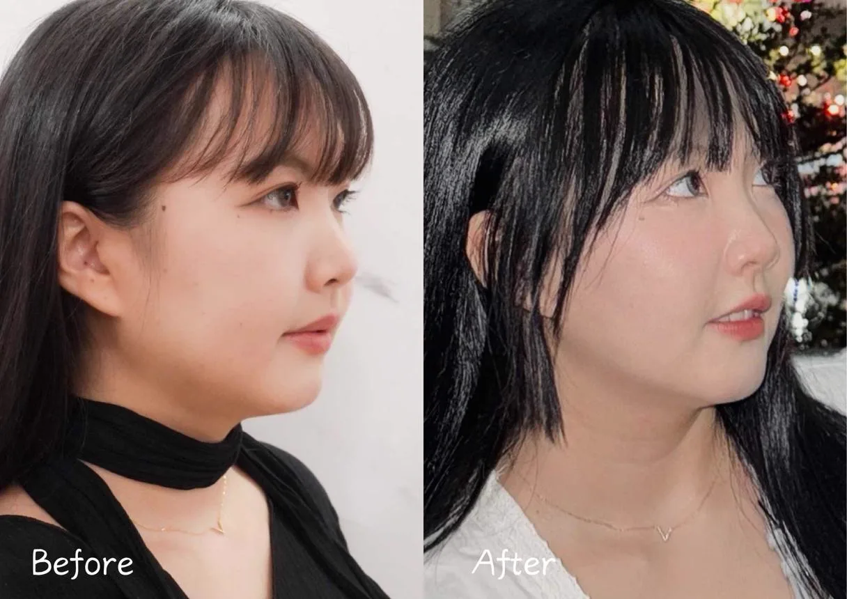 2. Jawline Slimming & Definition (Combination Treatments) image 1