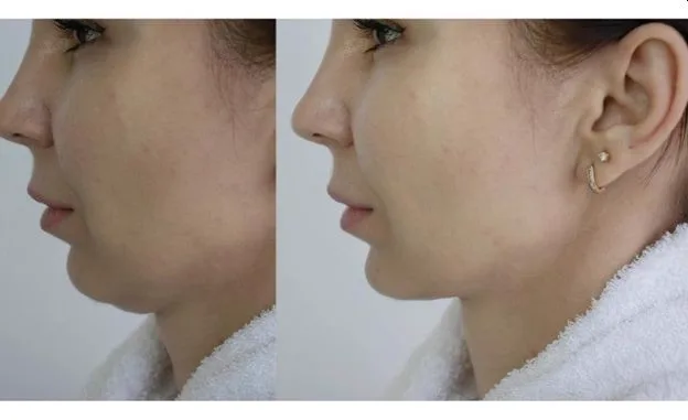 2. Jawline Thread Lift (Face Contouring)