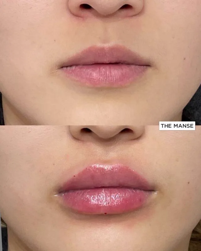 1. Lip Augmentation (Volume Enhancement) image 2