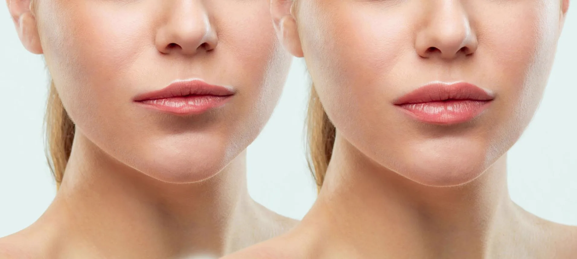 1. Lip Augmentation (Volume Enhancement) image 3