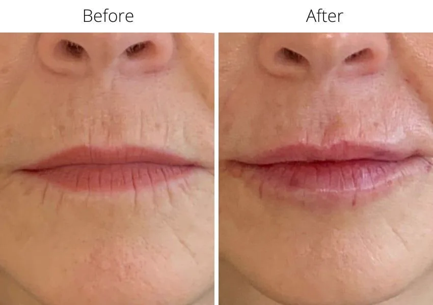 5. Lip Correction & Anti-Aging Lip Fillers image 1