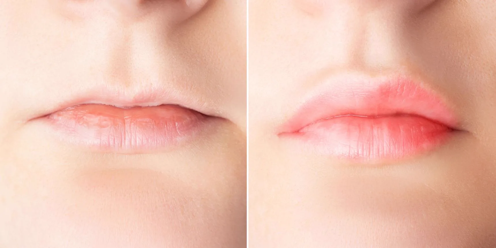 5. Lip Correction & Anti-Aging Lip Fillers image 3