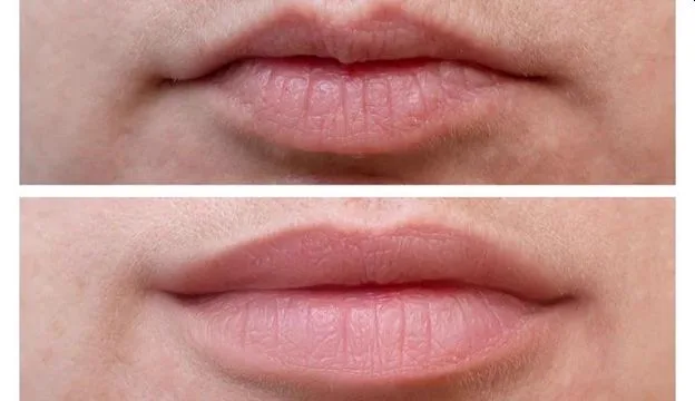 6. Lip Flip (Subtle Lip Enhancement) image 1