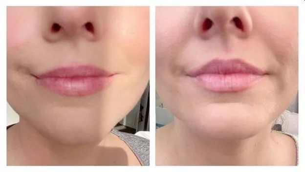 6. Lip Flip (Subtle Lip Enhancement) image 3