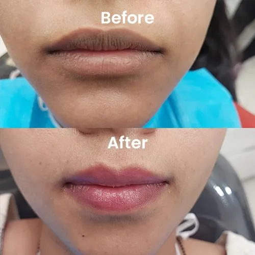 1. Lip Micropigmentation (Lip Blush) in Guwahati image 1