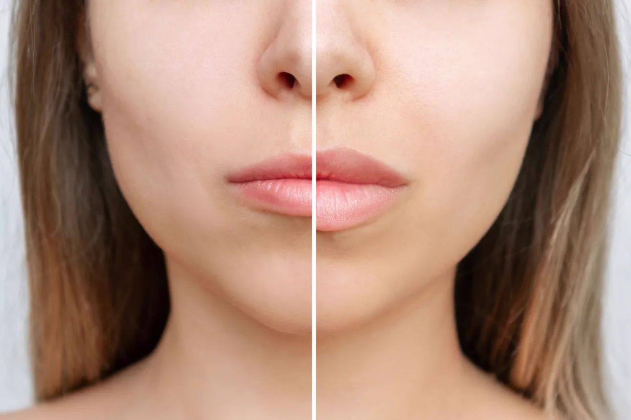 2. Lip Shape & Contour Correction image 2