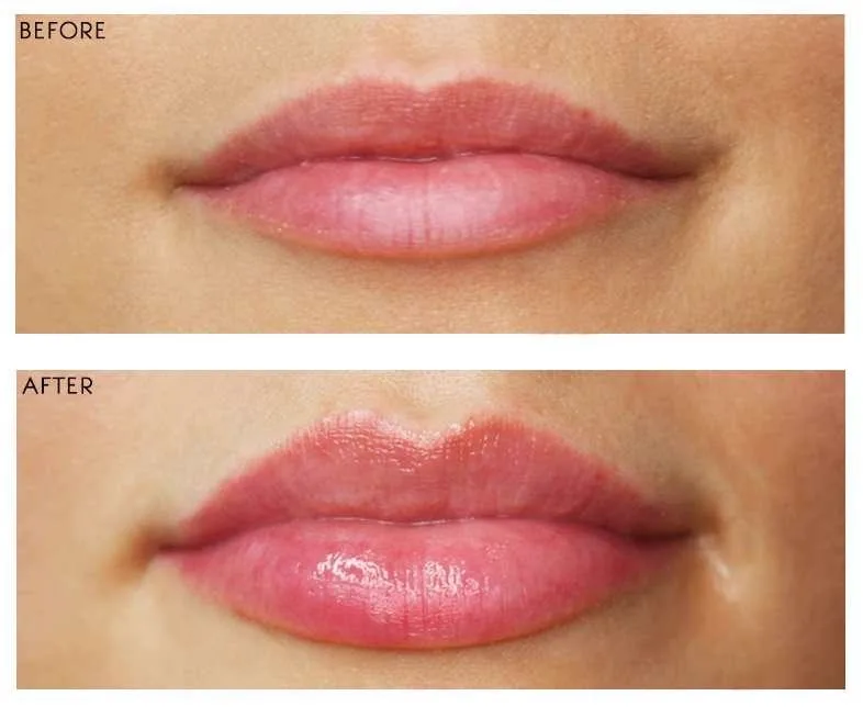 2. Lip Shape & Contour Correction image 3