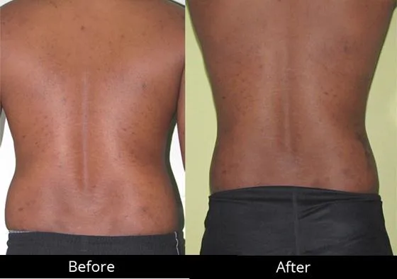 5. Liposuction + Fat Grafting Combination