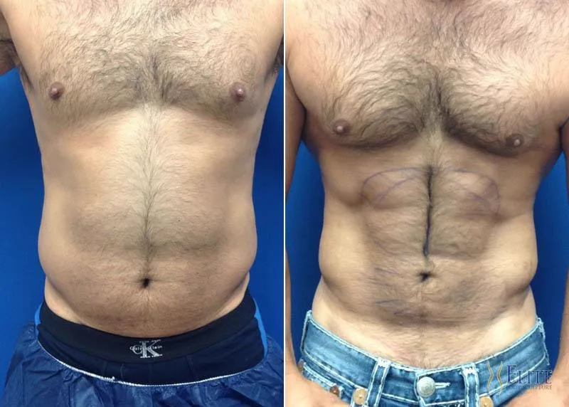 1. Liposuction (Fat Removal Surgery) image 1
