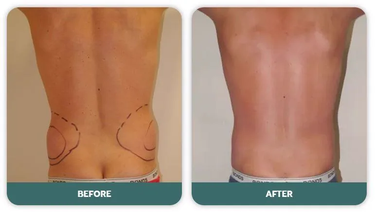 1. Liposuction (Fat Removal Surgery) image 2