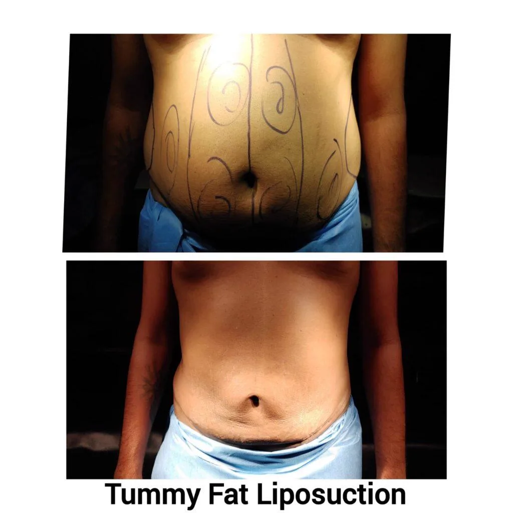 1. Liposuction (Fat Removal Surgery) image 3