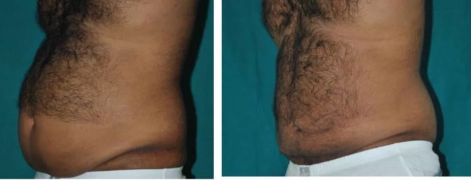 5. Liposuction with Fat Transfer image 1